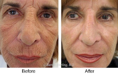 facial wrinkle Deep peel