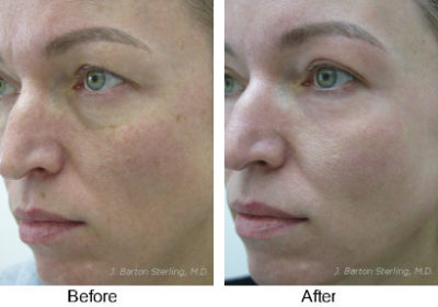 Chemical Peel & Laser Skin Treatments- J. Barton Sterling, MD