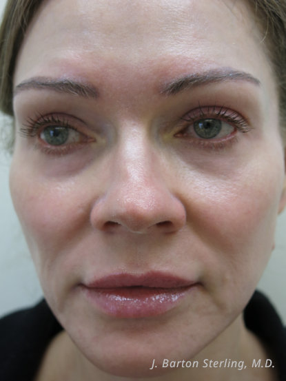 Chemical Peel 2024May After