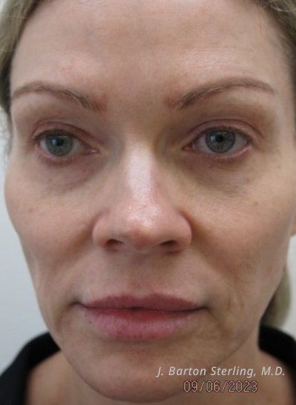 Chemical Peel 2024May Before